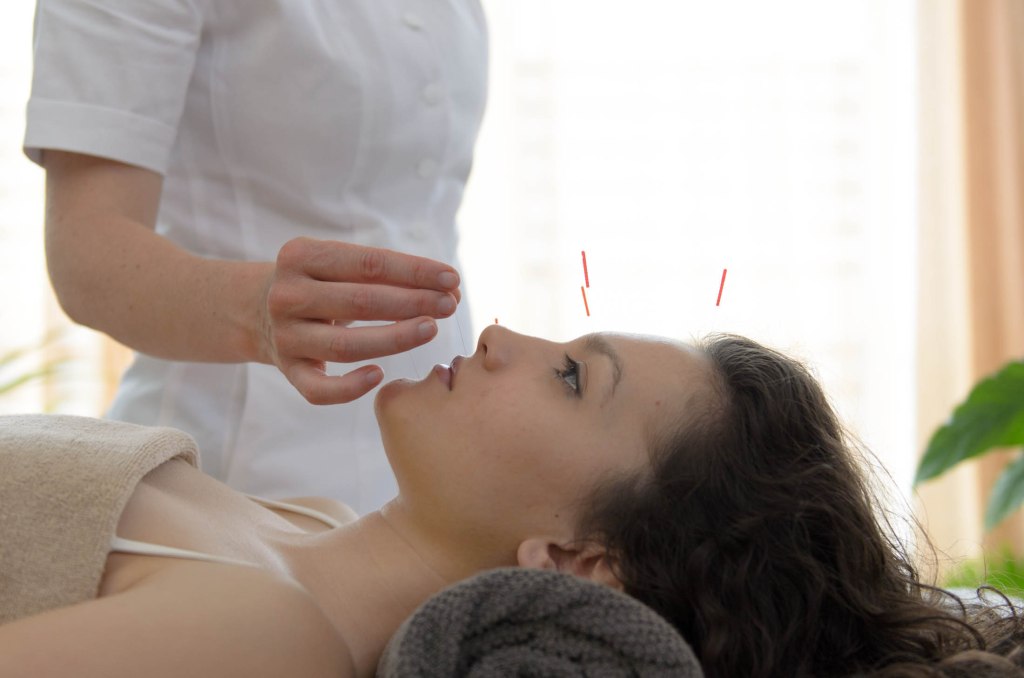 needling age out with&nbsp;acupuncture